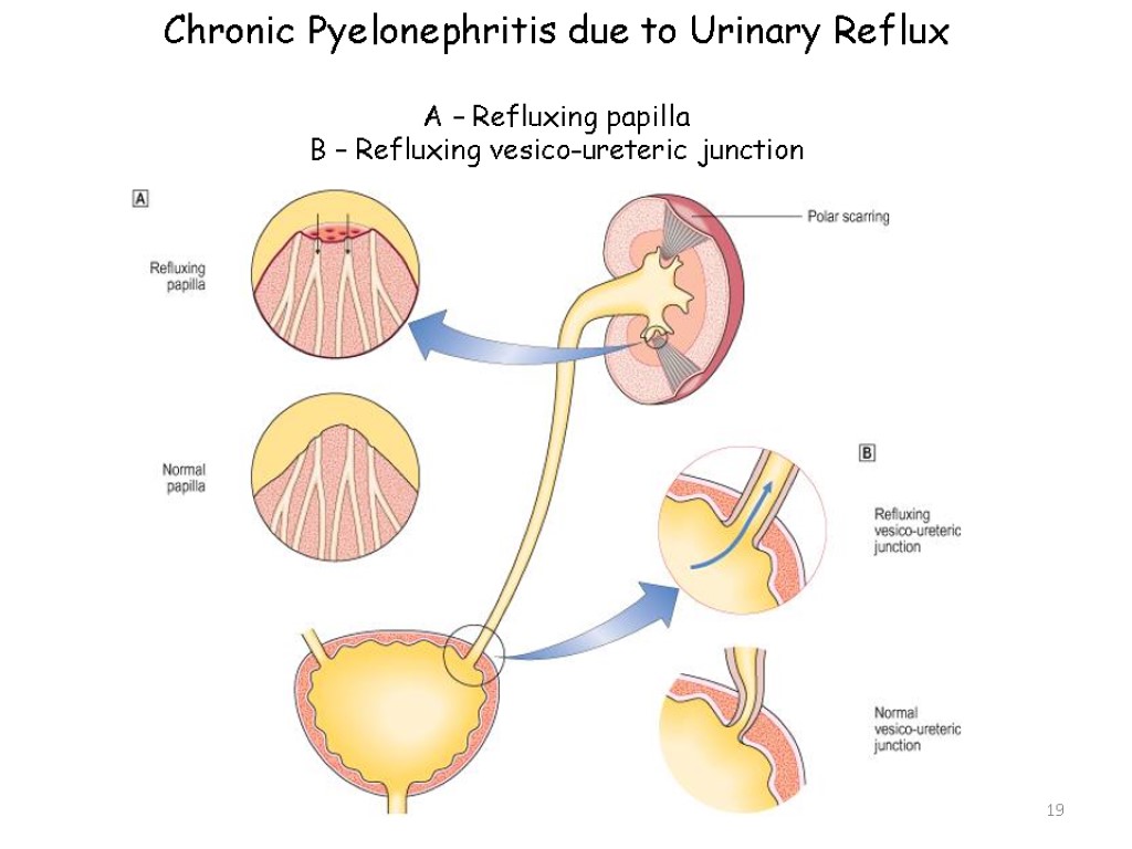 19 Chronic Pyelonephritis due to Urinary Reflux A – Refluxing papilla B – Refluxing